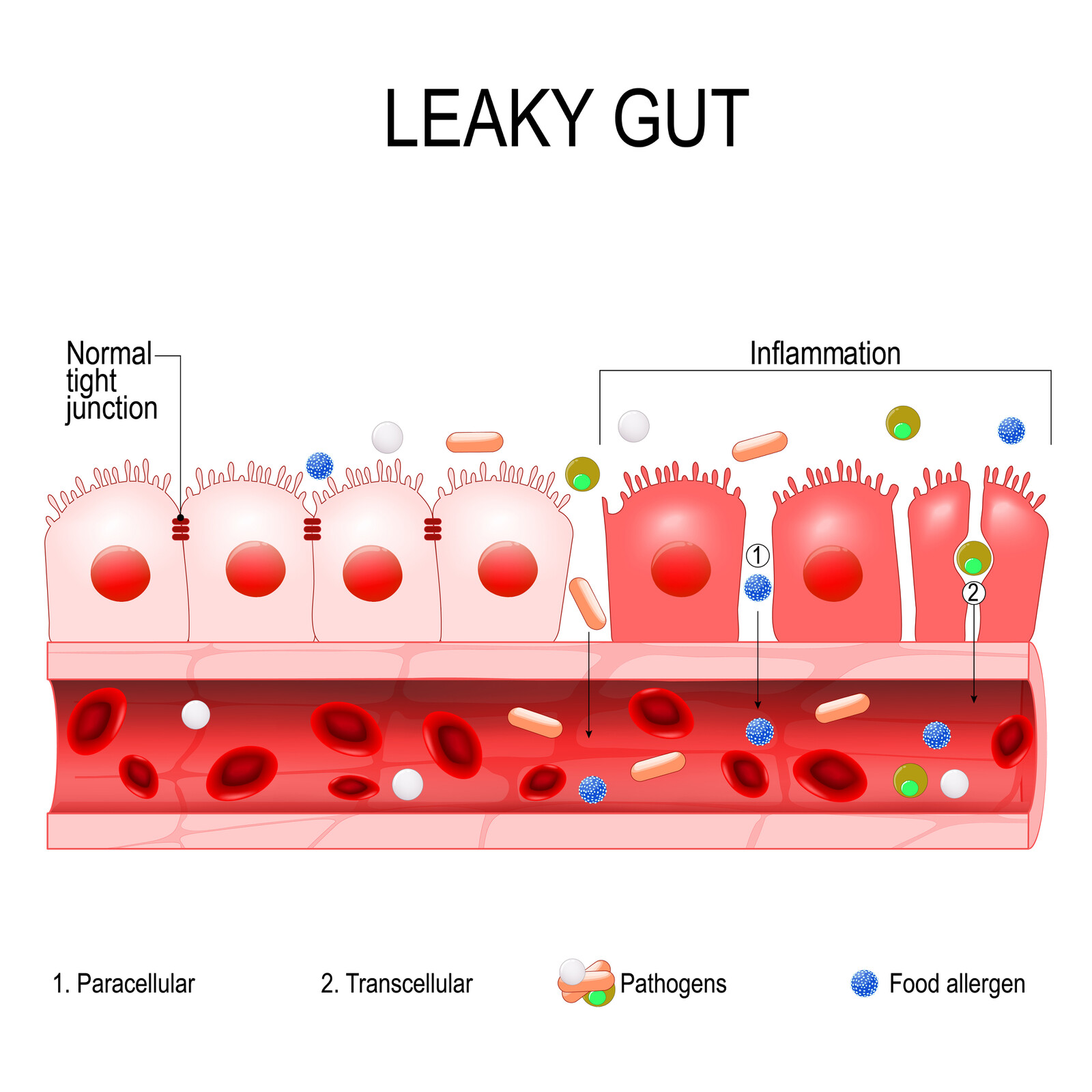 Een leaky gut geeft een verhoogd risico op een leaky brain